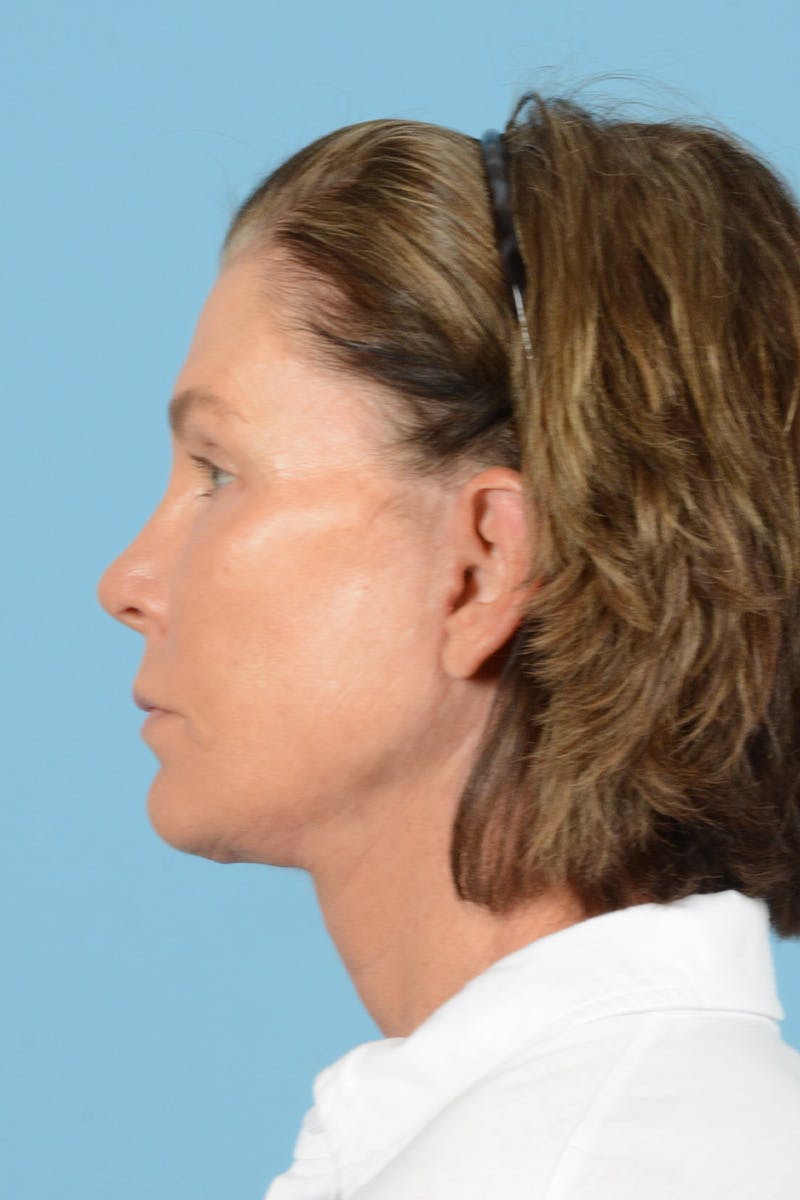 Endoscopic Brow Lift Before & After Gallery - Patient 169550 - Image 10