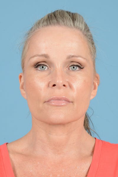 Endoscopic Brow Lift Before & After Gallery - Patient 283734 - Image 2