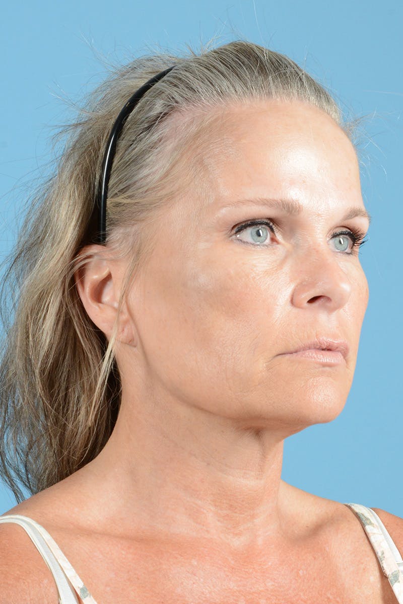 Endoscopic Brow Lift Before & After Gallery - Patient 283734 - Image 3