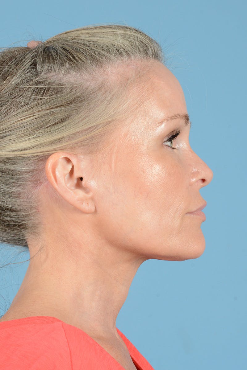 Endoscopic Brow Lift Before & After Gallery - Patient 283734 - Image 6