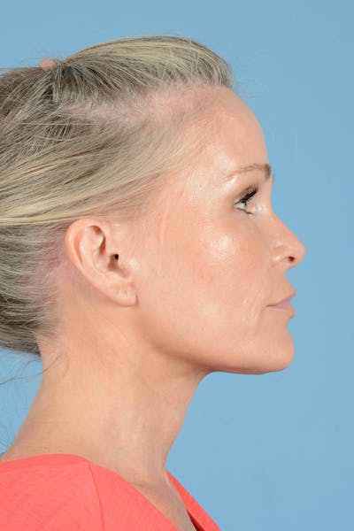 Endoscopic Brow Lift Before & After Gallery - Patient 283734 - Image 6