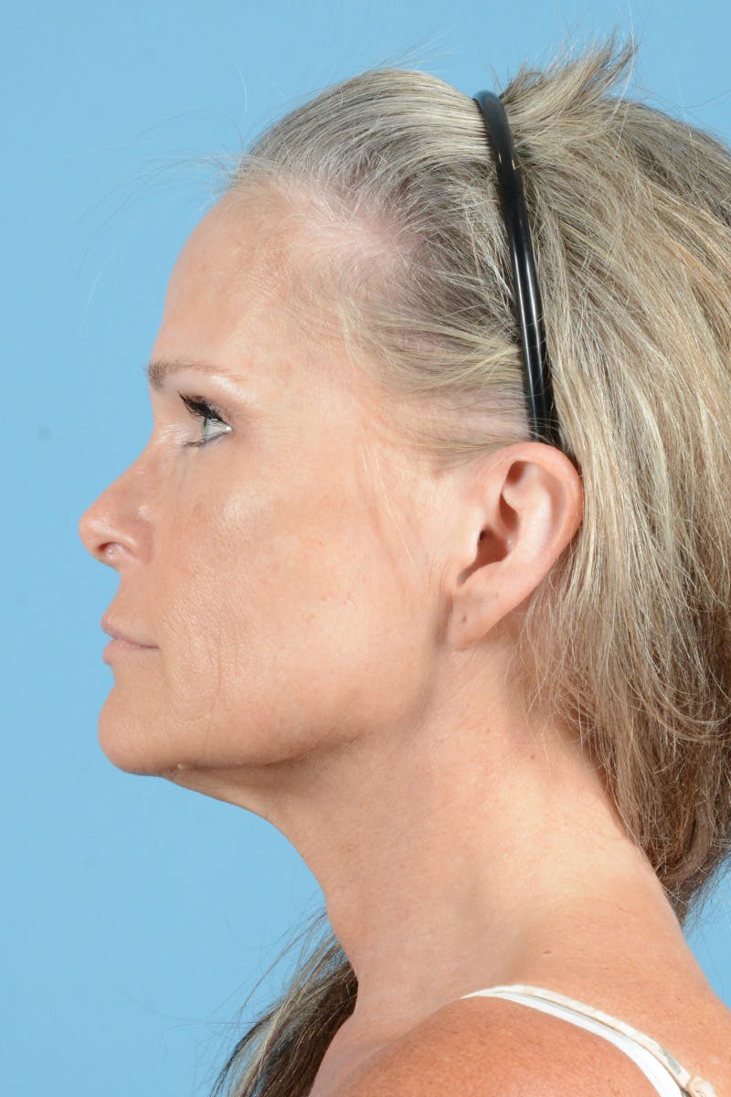 Endoscopic Brow Lift Before & After Gallery - Patient 283734 - Image 9