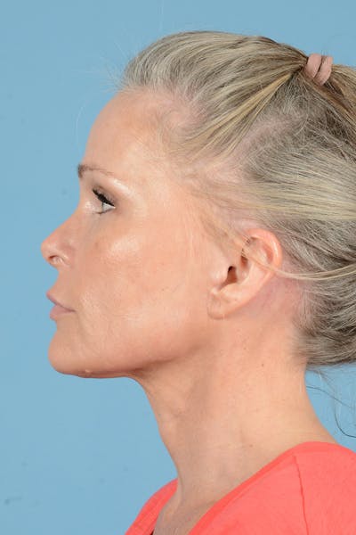 Endoscopic Brow Lift Before & After Gallery - Patient 283734 - Image 10