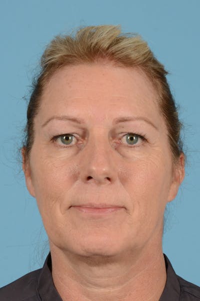 Endoscopic Brow Lift Before & After Gallery - Patient 113987 - Image 1