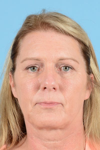 Endoscopic Brow Lift Before & After Gallery - Patient 113987 - Image 2