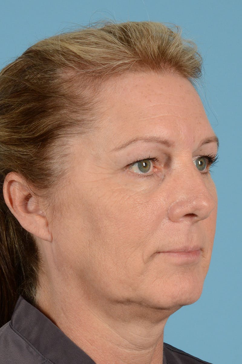 Endoscopic Brow Lift Before & After Gallery - Patient 113987 - Image 3