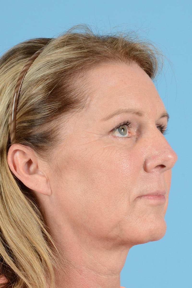 Endoscopic Brow Lift Before & After Gallery - Patient 113987 - Image 4