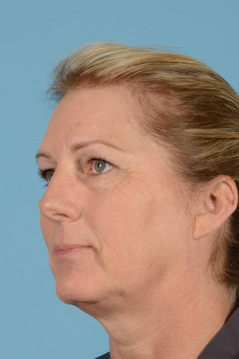 Endoscopic Brow Lift Before & After Gallery - Patient 113987 - Image 5