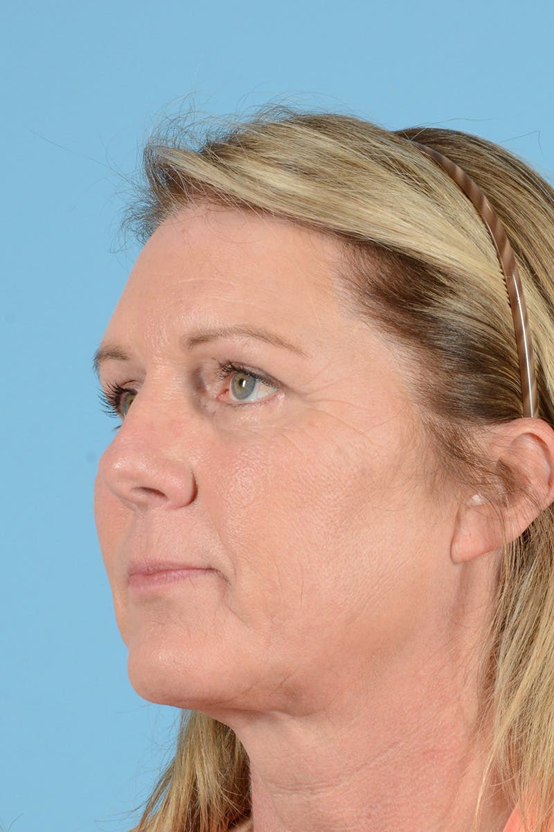 Endoscopic Brow Lift Before & After Gallery - Patient 113987 - Image 6
