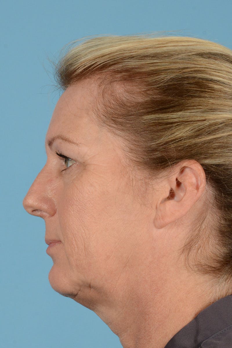 Endoscopic Brow Lift Before & After Gallery - Patient 113987 - Image 7