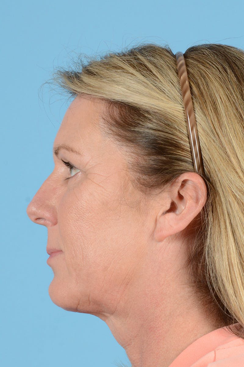 Endoscopic Brow Lift Before & After Gallery - Patient 113987 - Image 8