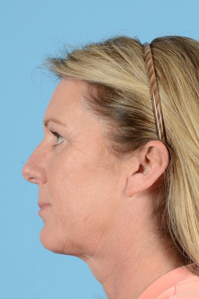 Endoscopic Brow Lift Before & After Gallery - Patient 113987 - Image 8
