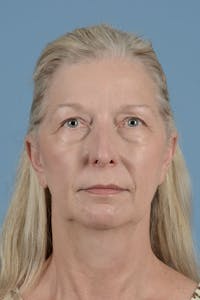 Endoscopic Brow Lift Before & After Gallery - Patient 425085 - Image 1