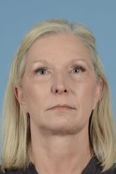 Endoscopic Brow Lift Before & After Gallery - Patient 425085 - Image 2