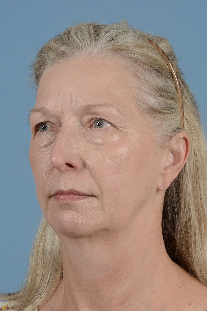 Endoscopic Brow Lift Before & After Gallery - Patient 425085 - Image 3