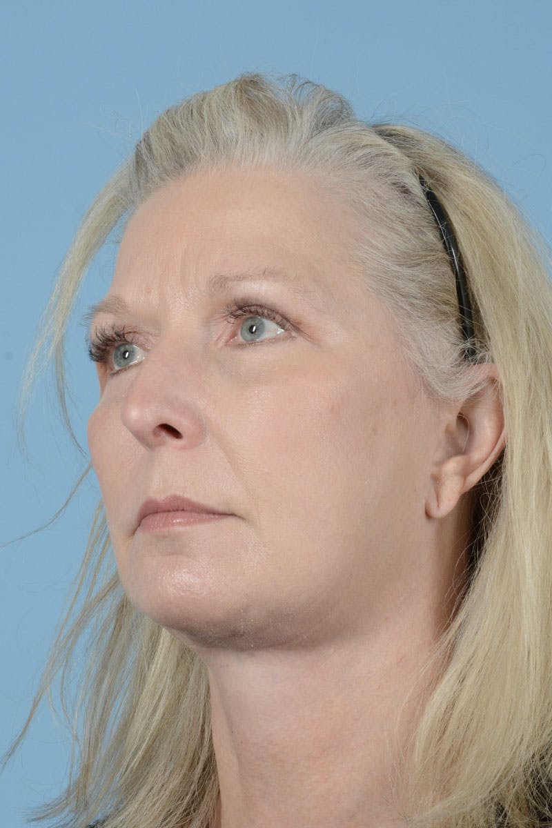 Endoscopic Brow Lift Before & After Gallery - Patient 425085 - Image 4