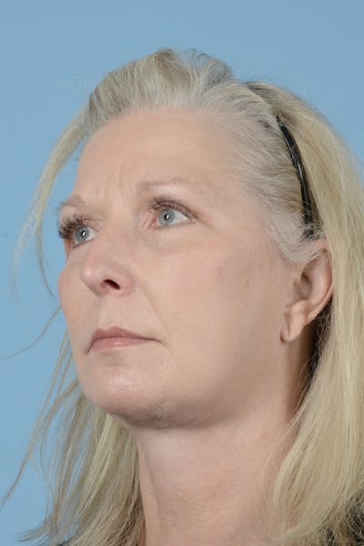 Endoscopic Brow Lift Before & After Gallery - Patient 425085 - Image 4