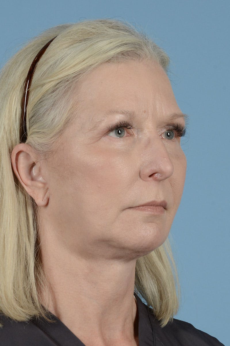 Endoscopic Brow Lift Before & After Gallery - Patient 425085 - Image 6
