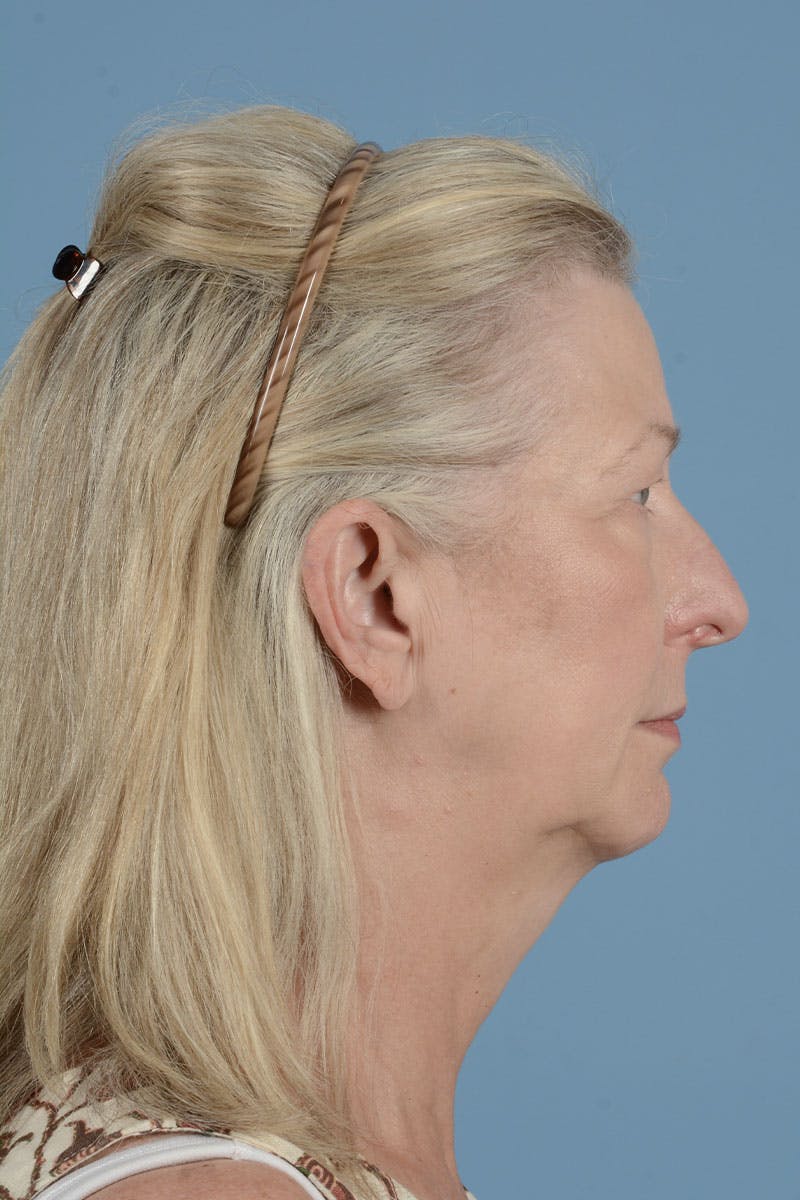 Endoscopic Brow Lift Before & After Gallery - Patient 425085 - Image 7