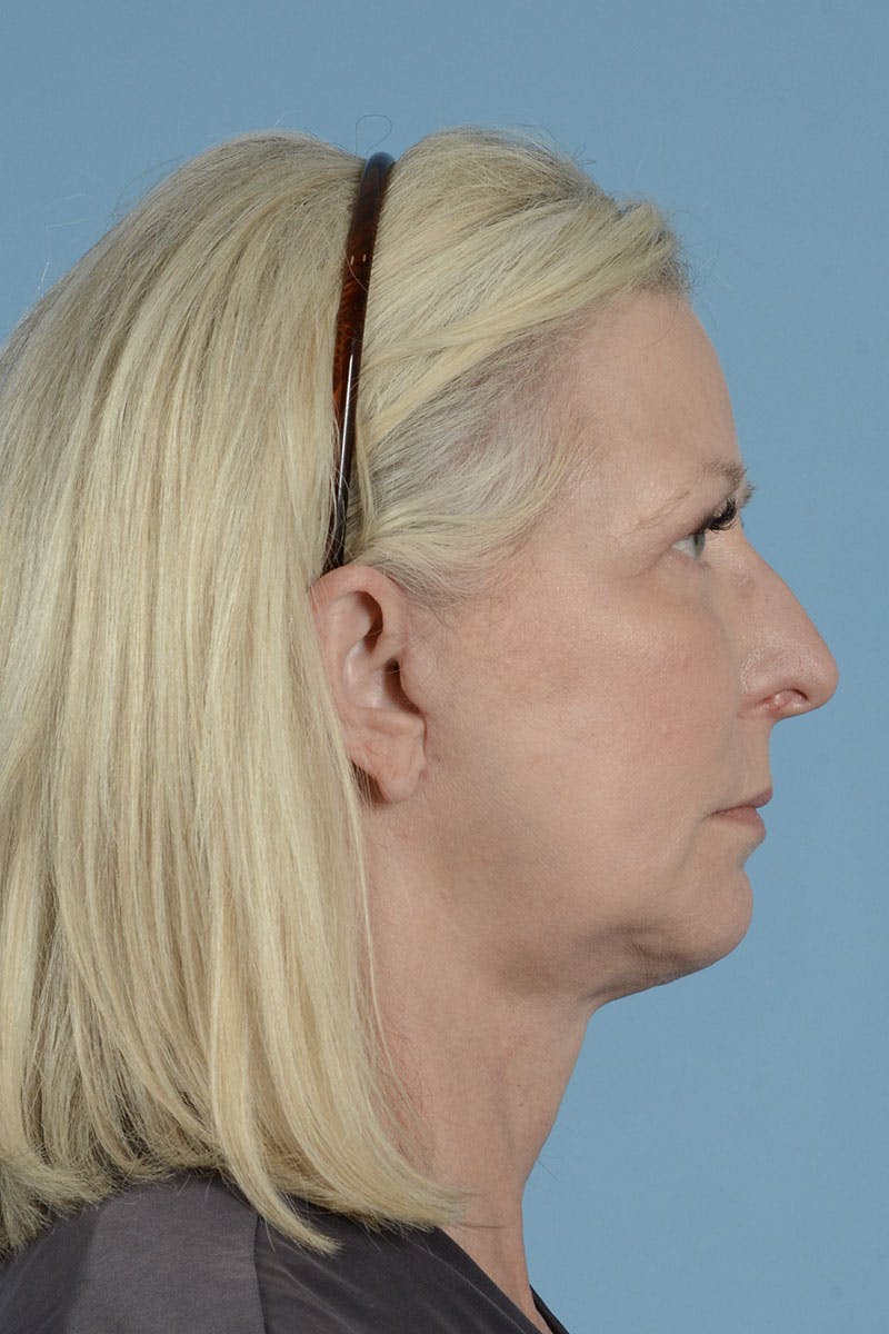 Endoscopic Brow Lift Before & After Gallery - Patient 425085 - Image 8