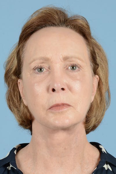 Endoscopic Brow Lift Before & After Gallery - Patient 418461 - Image 2
