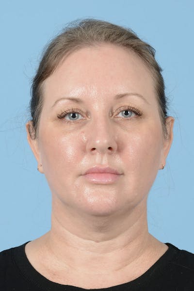Endoscopic Brow Lift Before & After Gallery - Patient 659641 - Image 1