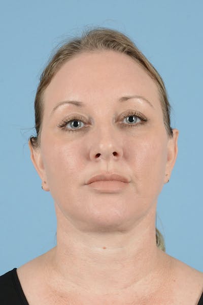 Endoscopic Brow Lift Before & After Gallery - Patient 659641 - Image 2