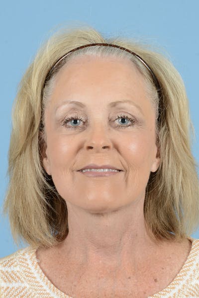 Endoscopic Brow Lift Before & After Gallery - Patient 368055 - Image 2