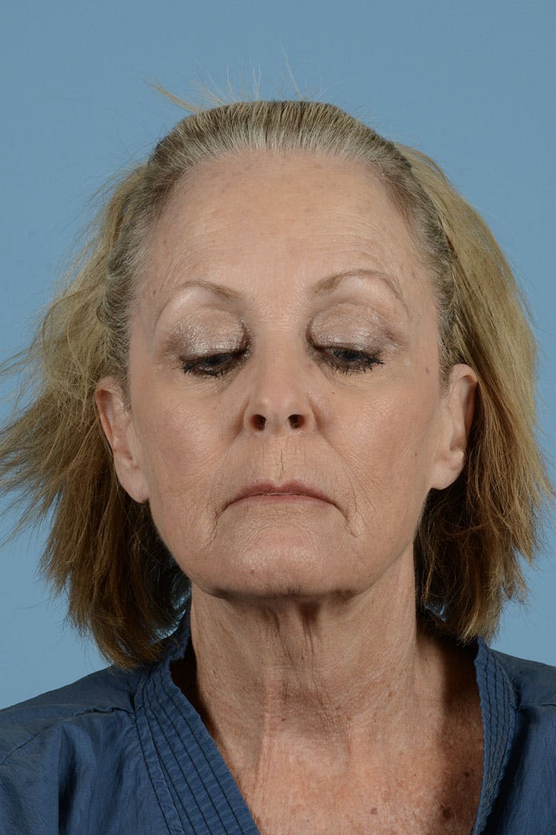 Endoscopic Brow Lift Before & After Gallery - Patient 368055 - Image 3