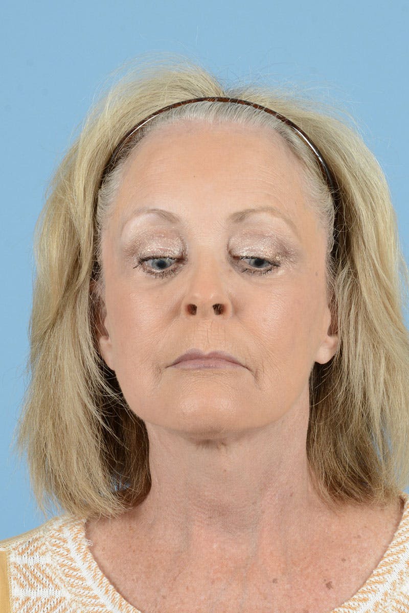 Endoscopic Brow Lift Before & After Gallery - Patient 368055 - Image 4