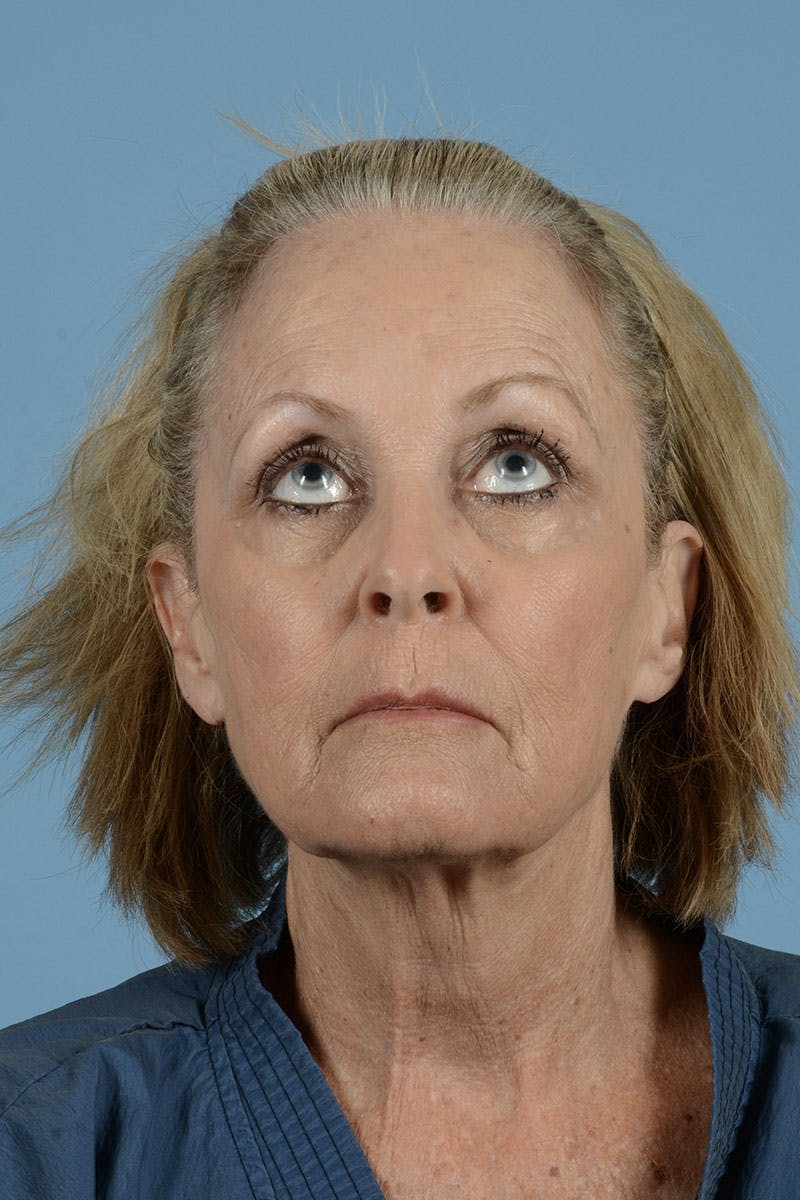 Endoscopic Brow Lift Before & After Gallery - Patient 368055 - Image 5