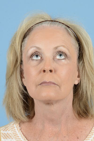 Endoscopic Brow Lift Before & After Gallery - Patient 368055 - Image 6
