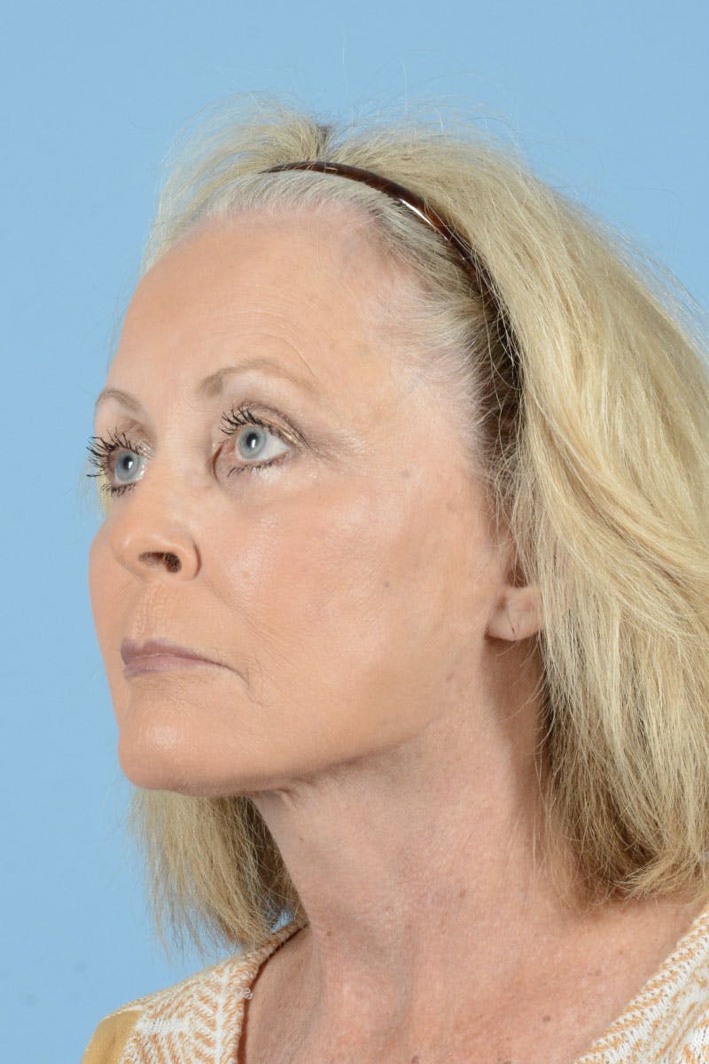 Endoscopic Brow Lift Before & After Gallery - Patient 368055 - Image 8