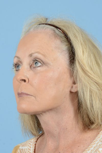 Endoscopic Brow Lift Before & After Gallery - Patient 368055 - Image 8