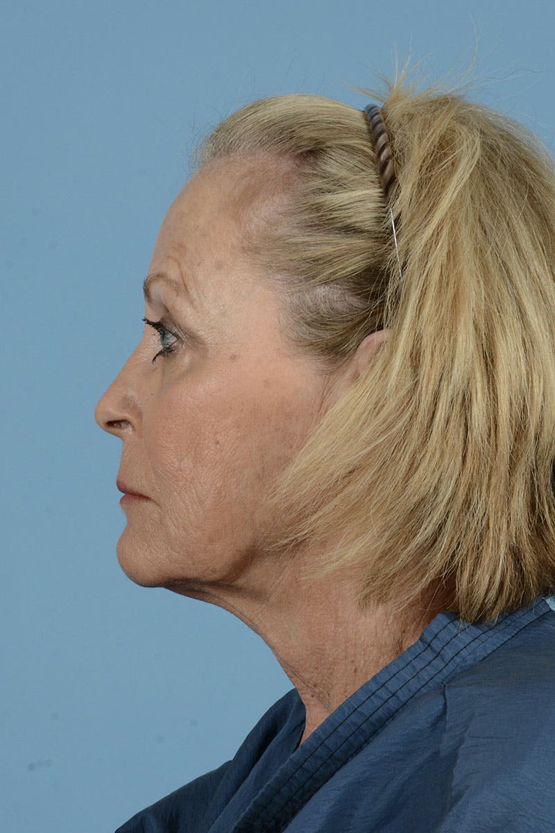 Endoscopic Brow Lift Before & After Gallery - Patient 368055 - Image 9