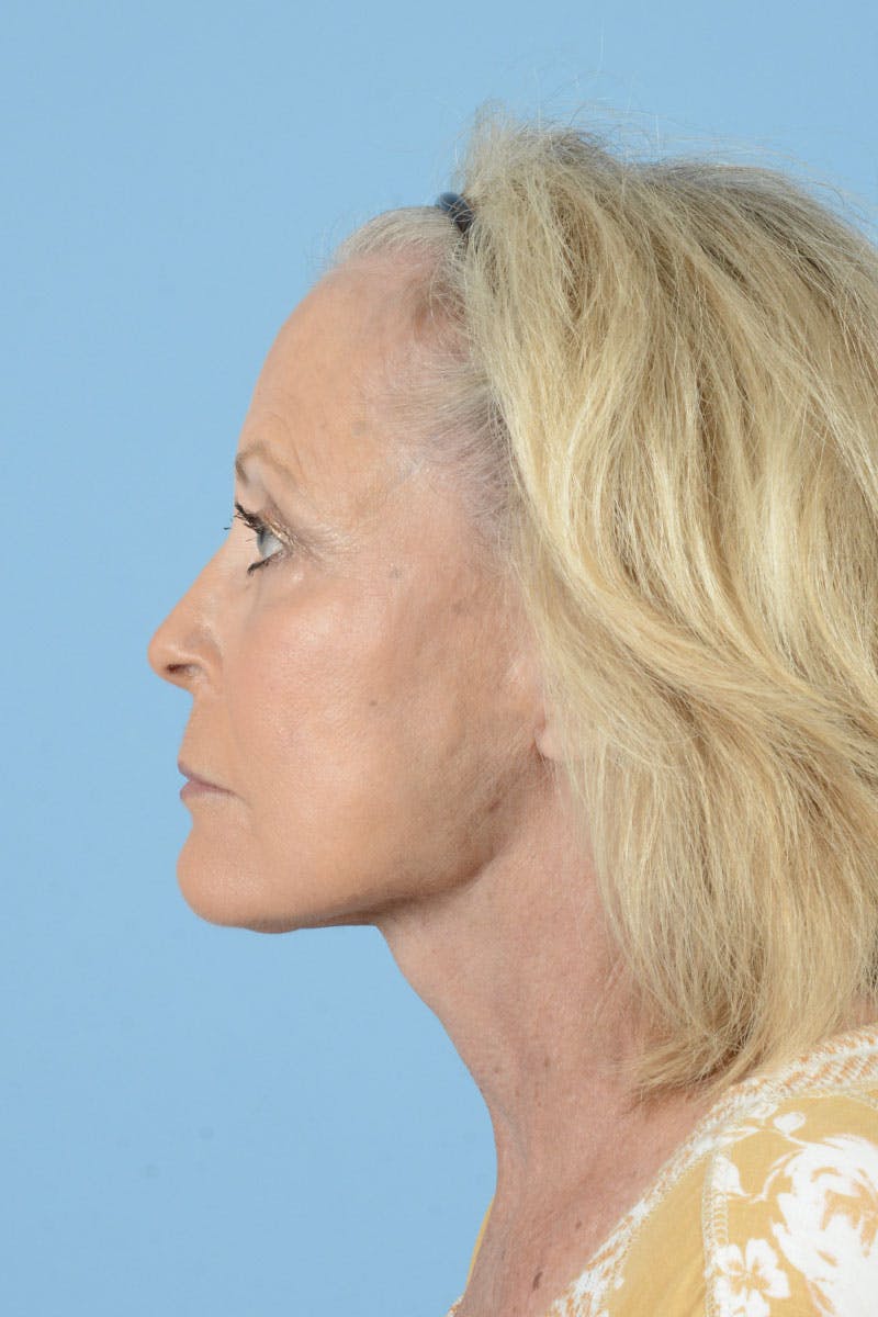 Endoscopic Brow Lift Before & After Gallery - Patient 368055 - Image 10