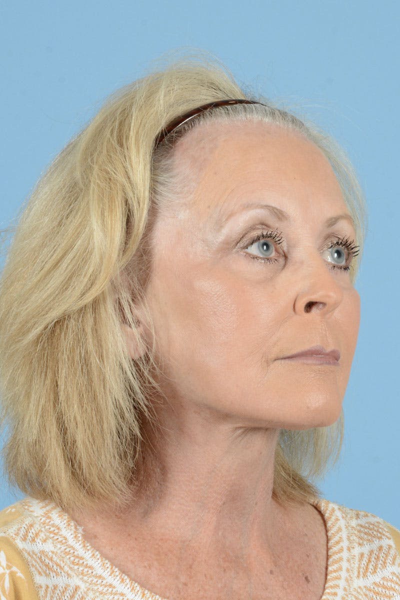 Endoscopic Brow Lift Before & After Gallery - Patient 368055 - Image 12