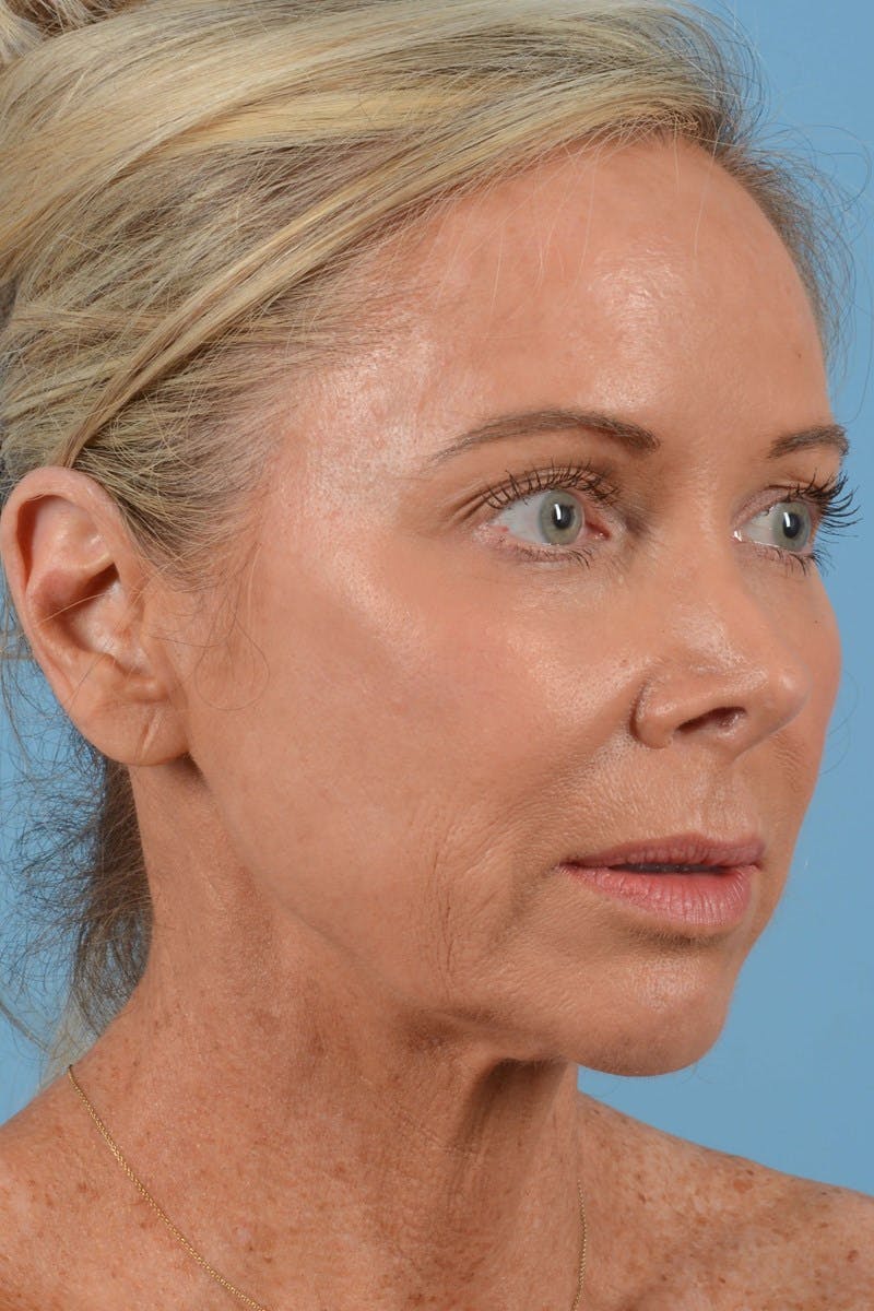 Endoscopic Brow Lift Before & After Gallery - Patient 137350 - Image 1