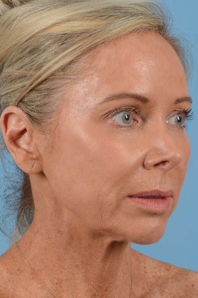 Endoscopic Brow Lift Before & After Gallery - Patient 137350 - Image 1