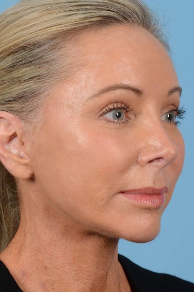 Endoscopic Brow Lift Before & After Gallery - Patient 137350 - Image 2