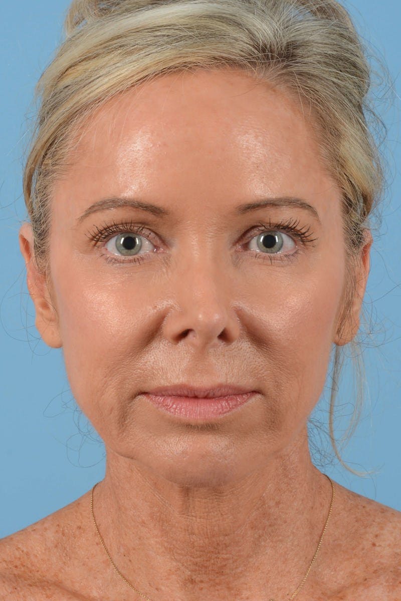 Endoscopic Brow Lift Before & After Gallery - Patient 137350 - Image 3