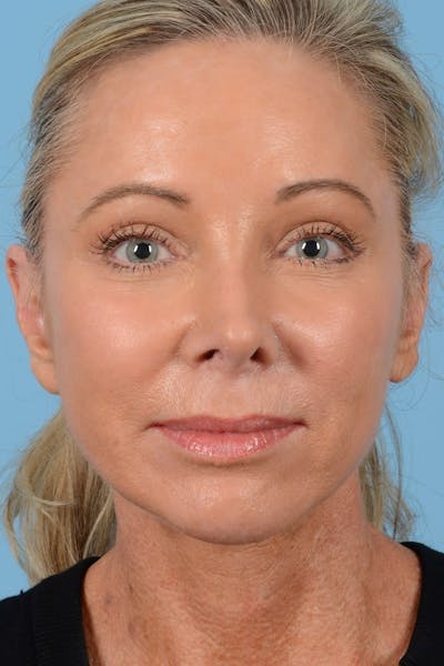 Endoscopic Brow Lift Before & After Gallery - Patient 137350 - Image 4