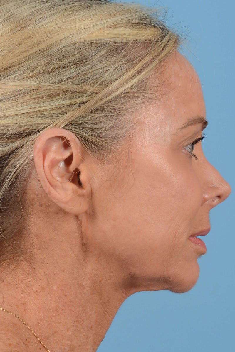 Endoscopic Brow Lift Before & After Gallery - Patient 137350 - Image 5
