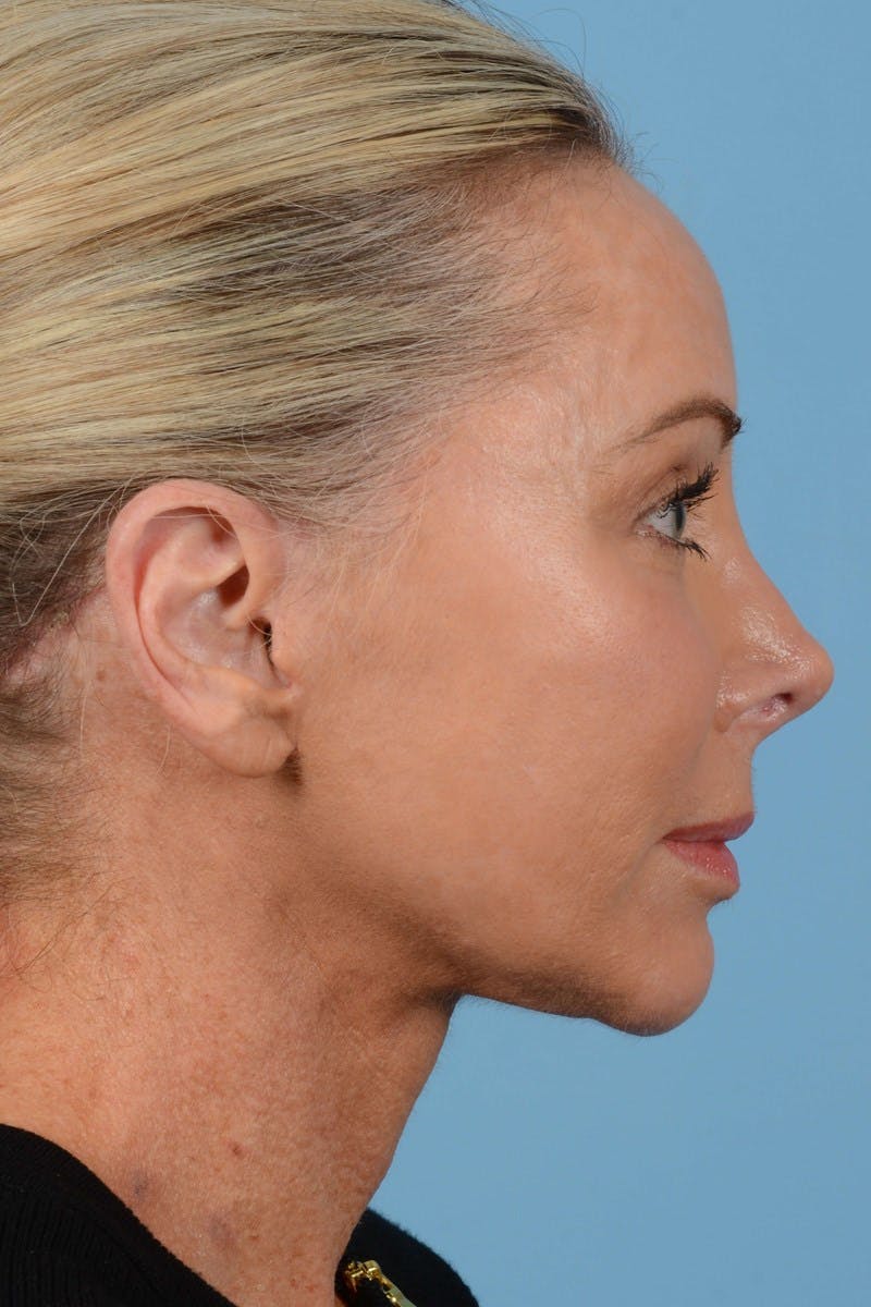 Endoscopic Brow Lift Before & After Gallery - Patient 137350 - Image 6