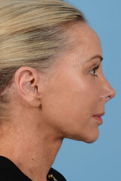 Endoscopic Brow Lift Before & After Gallery - Patient 137350 - Image 6