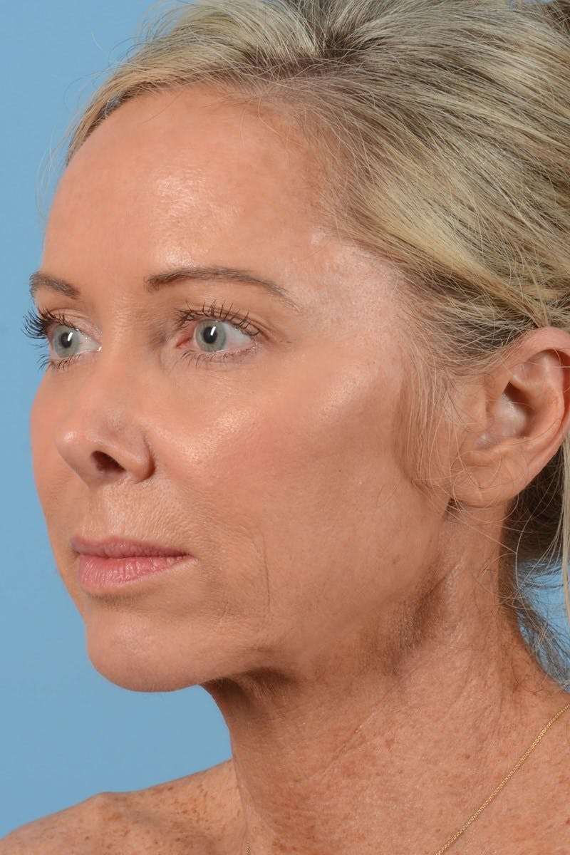 Endoscopic Brow Lift Before & After Gallery - Patient 137350 - Image 7