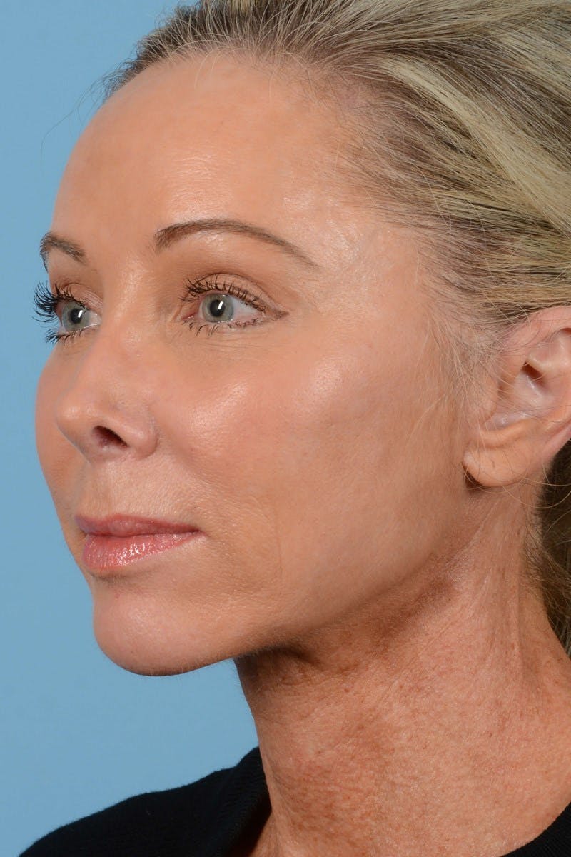 Endoscopic Brow Lift Before & After Gallery - Patient 137350 - Image 8