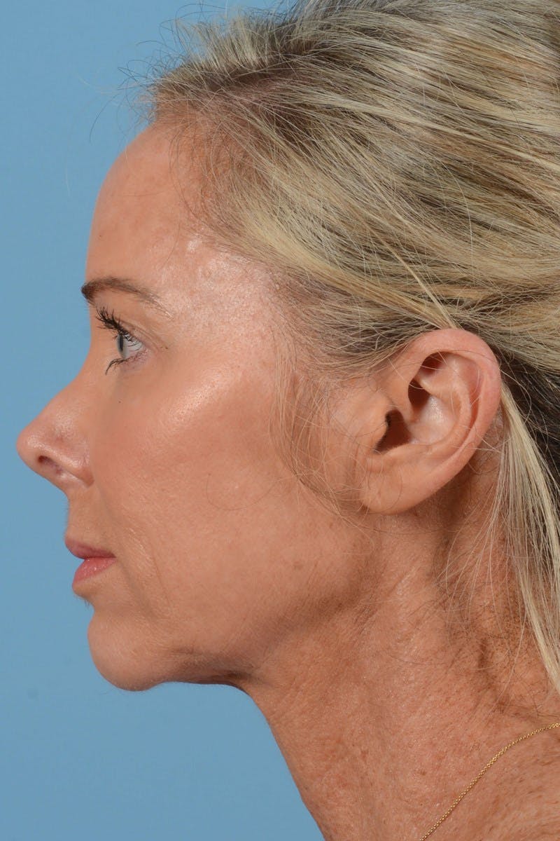 Endoscopic Brow Lift Before & After Gallery - Patient 137350 - Image 9