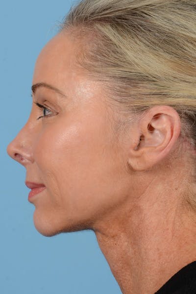 Endoscopic Brow Lift Before & After Gallery - Patient 137350 - Image 10