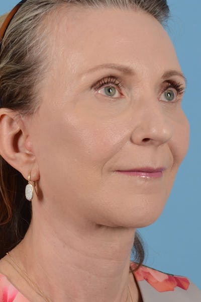 Endoscopic Brow Lift Before & After Gallery - Patient 177960 - Image 2